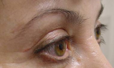 Scar after blepharoplasty: why it occurs and how to treat it